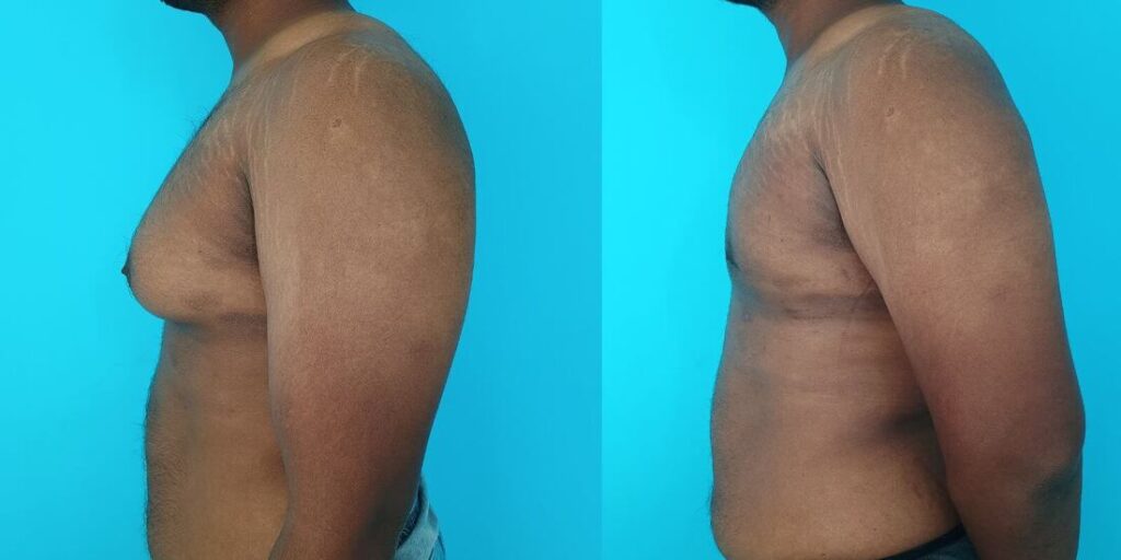Gynecomastia