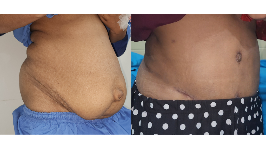Tummy Tuck